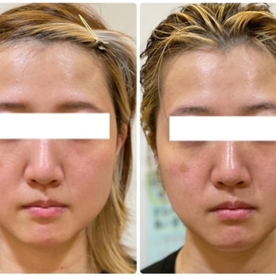 エアバリ　美容機器 業務用美顔器エアバリとは？｜機械の値段や特徴・効果などご紹介